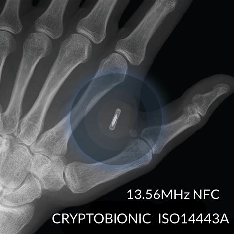 implant nfc tag|rfid microchip implant.